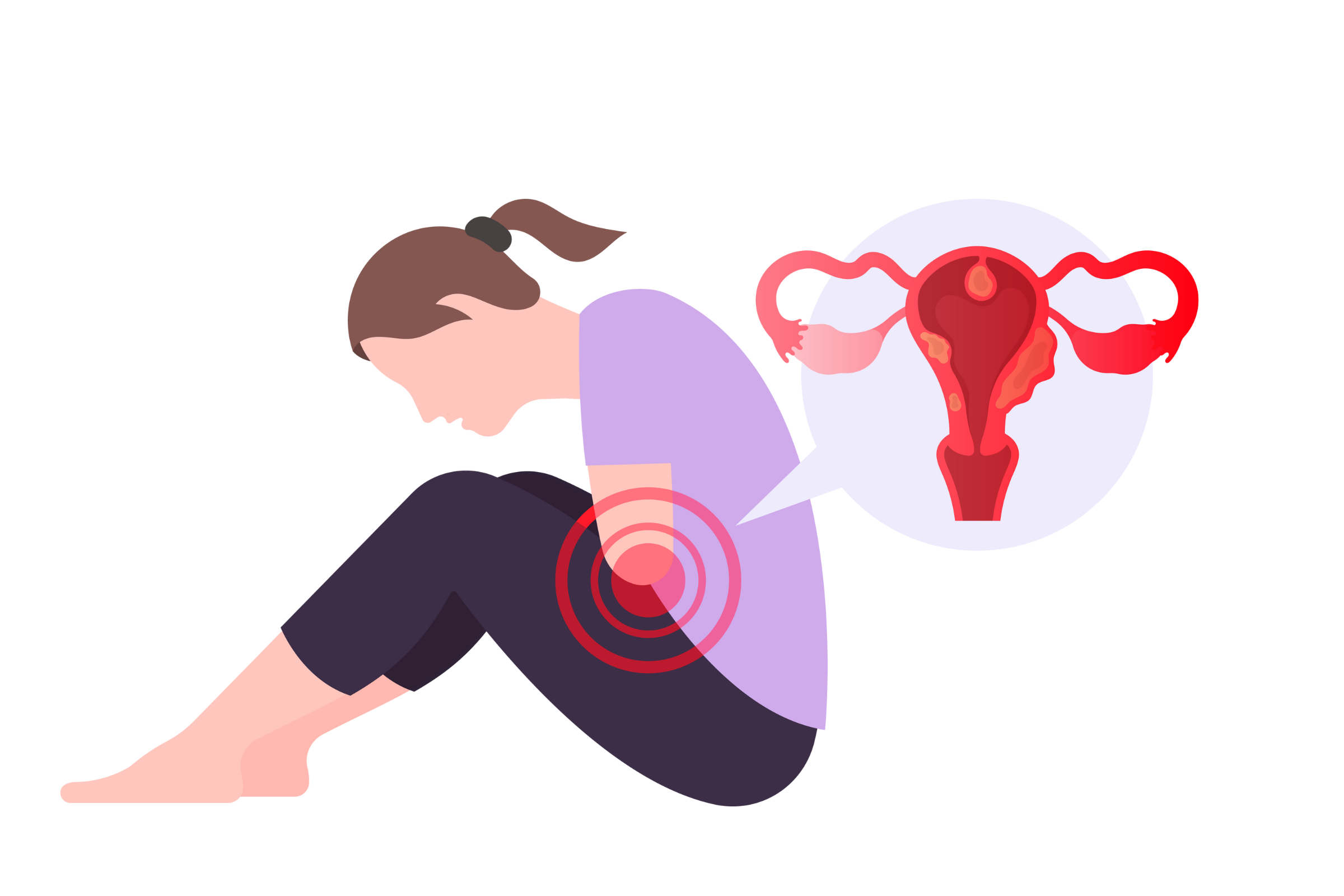 endometriosis png